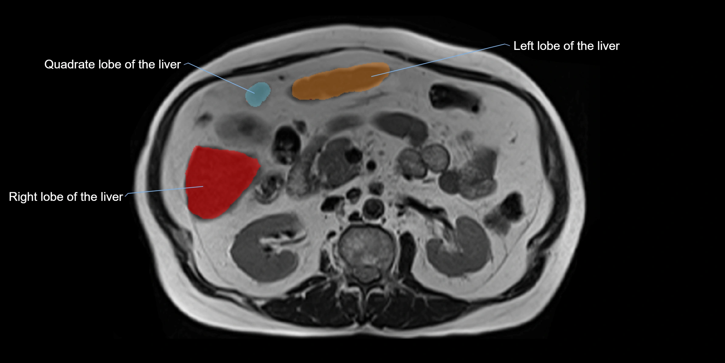 MRI liver lobe axial cross sectional 3T radiology  image-img-00001-00021.webp